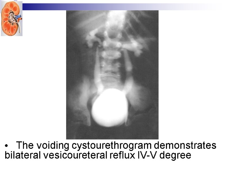 The voiding cystourethrogram demonstrates bilateral vesicoureteral reflux IV-V degree